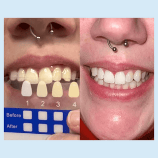 Advanced Wireless Teeth Whitening Kit